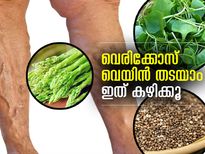 വെരിക്കോസ് വെയിന്‍ തടയാം; ഇതൊക്കെ കഴിച്ചാല്‍ മതി