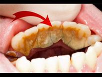 പല്ല് ഇങ്ങനെയാവേണ്ടെങ്കില്‍ ഈ കുഞ്ഞ് കാര്യം ശ്രദ്ധിക്കണം