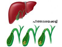 കുട്ടികളിലെ പിത്താശയക്കല്ല്; ശ്രദ്ധിച്ചില്ലെങ്കില്‍ അപകടം