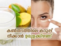 കണ്‍തടത്തിലെ കറുപ്പ് നീക്കാന്‍ ഉരുളക്കിഴങ്ങ് പ്രയോഗം