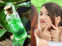 മുഖക്കുരു നിശ്ശേഷം നീക്കും ഈ എണ്ണ