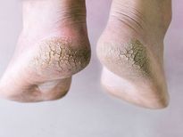  വിനാഗിരിയില്‍ കാല്‍ മുക്കി വെക്കൂ; 5 ദിവസം മതി ഈ പ്രശ്‌നം പരിഹരിക്കാം