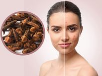 ഗ്രാമ്പൂ ഇങ്ങനെയെങ്കില്‍ മുഖക്കുരുവും കറുത്തപാടും ഇല്ലേയില്ല