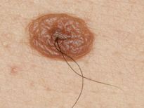  നിങ്ങളുടെ മറുകില്‍ ക്യാന്‍സര്‍ വളരുന്നുണ്ടോ, അറിയാന്‍ ഈ ലക്ഷണം