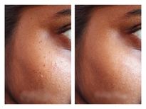 ചര്‍മ്മത്തിലെ കറുത്ത പാടുകള്‍ നിസ്സാരമല്ല; കാരണങ്ങള്‍ ഇവയാണ്