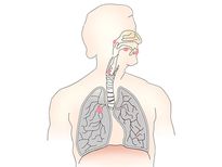 ശരീരത്തില്‍ ഒരു ഭാഗത്ത് ബാധിച്ച ക്യാന്‍സര്‍ പടരുന്നത് എങ്ങനെ?