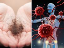 കോവിഡ് വന്നുമാറിയശേഷം മുടി കൊഴിയുന്നതിന് കാരണം ഇതാണ്‌