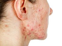 മുഖത്ത് ചുവന്ന ചെതുമ്പല്‍ പോലെ പാടുകളുണ്ടോ; കാരണം നിസ്സാരമല്ല