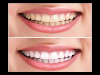 ഈ 6 പൊടിക്കൈകളില്‍ മുത്ത് പോലെ തിളങ്ങും പല്ലുകള്‍