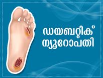 കാല് വരെ മുറിച്ചുമാറ്റണം; ഡയബറ്റിക് ന്യൂറോപ്പതി ഭീകരമാകുന്നത് ഇങ്ങനെ