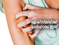 എക്‌സിമയ്ക്ക് പരിഹാരം വീട്ടില്‍ തന്നെയുണ്ട്; ഇതാണ് പോംവഴി