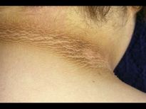 കഴുത്തിലെ കറുപ്പ് നിസ്സാരമല്ല കാരണമറിഞ്ഞ് പരിഹരിക്കണം