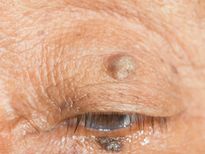 കണ്‍പീലിയിലെ അരിമ്പാറ നിസ്സാരമല്ല:  കളയും മുന്‍പ് അറിയണം ഇക്കാര്യം