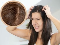 ചൂട് കൂടിയാല്‍ താരനും കൂടും; ചെറുക്കാനുള്ള എളുപ്പ പ്രതിവിധി ഇതാണ്