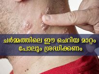 ഷിംഗിള്‍സ് നിസ്സാരമല്ല: അപകട ലക്ഷണങ്ങള്‍ നിസ്സാരമാക്കരുത്