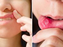 അപകടകരം, വായിലെ അര്‍ബുദം; ഈ മാറ്റം ശീലിച്ചാല്‍ രക്ഷ