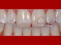 പല്ലില്‍ വെളുത്ത കുത്തുകള്‍ കാണുന്നോ: പൂര്‍ണ പരിഹാരം ഇവിടുണ്ട്