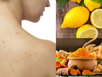 വേനലില്‍ പതിവായി പുറത്തും തോളിലും കുരുക്കള്‍ വരാറുണ്ടോ? പ്രതിവിധി ഇത്