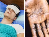 കോവിഡിനിടെ ഭീതിയായി കുരങ്ങുപനിയും; ലക്ഷണങ്ങള്‍ വേര്‍തിരിച്ചറിയാം