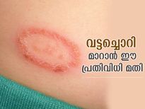 അസഹ്യമായ ചൊറിച്ചിലുണ്ടാക്കുന്ന വട്ടച്ചൊറി; ഈ വീട്ടുവൈദ്യമാണ് പരിഹാരം