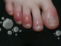 മഴക്കാലത്ത് കാലൊന്ന് ശ്രദ്ധിക്കണം: അണുബാധ നിസ്സാരമല്ല