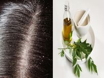 താരനേയും ചൊറിച്ചിലിനേയും പൂര്‍ണമായും മാറ്റാന്‍ മൂന്ന് ആര്യവേപ്പ് സൂത്രങ്ങള്‍