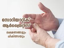 ശ്രദ്ധിച്ചില്ലെങ്കില്‍ പ്രശ്‌നമാകും; സോറിയാറ്റിക് ആര്‍ത്രൈറ്റിസ് ലക്ഷണങ്ങളും ചികിത്സയും