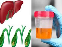 ഇരുണ്ട മൂത്രവും വയറുവേദനയും നിസ്സാരമല്ല: അപകടം അകത്താണ്