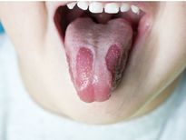  ചൂടുള്ള ഭക്ഷണവും തിളച്ച വെള്ളവും നാവ് പൊള്ളിച്ചോ, നിമിഷ പരിഹാരം