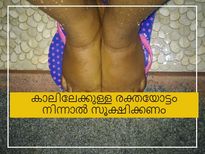 കാലിലേക്കുള്ള രക്തയോട്ടം നിലച്ചാല്‍ അപകടം: നീരും നിറം മാറ്റവും ശ്രദ്ധിക്കണം