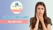  പല്ലിലെ പോട് നിസ്സാരമാക്കുന്നവര്‍ ശ്രദ്ധിക്കണം: പിന്നീടുള്ള അപകടത്തെ