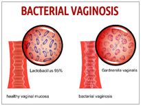 అసురక్షితమైన సంభోగం వల్ల బ్యాక్టీరియల్ ఇన్ఫెక్షన్ కు కారణమౌతుందా..?
