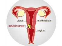 మదర్స్ డే స్పెషల్ : సర్వికల్ క్యాన్సర్ కు కారణాలు..నివారణ..!