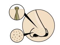 బ్లాక్ హెడ్స్ పోగొట్టే న్యాచురల్ హోం రెమెడీస్ !