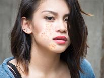 ఫేస్ బ్లిస్టర్స్ ను ఎఫెక్టివ్ గా పోగొట్టే హోం రెమెడీస్ 