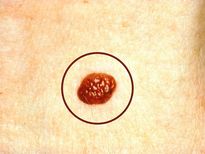 మెలనోమా (చర్మంమీది పుట్టకురుపు  లేదా చర్మ క్యాన్సర్) లక్షణాలు, కారణాలు మరియు నివారణ!