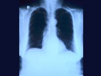  రోగి క‌డుపులో 263 నాణేలు, బ్లేడులు, మేకులు: ఆశ్చ‌ర్యంలో డాక్ట‌ర్లు! 