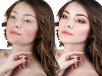   पिंपल भरे चेहरे के लिये अपनाइये शहनाज़ हुसैन के 8 ब्‍यूटी टिप्‍स 