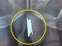 जब यौन संतुष्टि के लिए इस चायनीज शख्‍स ने अपने लिंग में डाल दी 15 सुईयां 