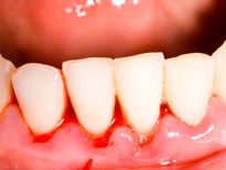 मसूड़ों की बीमारी के लक्षण, कारण और घरेलू उपाय, जानिए