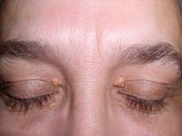 Xanthelasma: कैसे आंखों के आसपास जम जाता है कॉलेस्‍ट्रॉल, जानें लक्षण, वजह और इलाज 