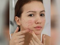 Skin Care Tips: हार्मोनल एक्ने से निजात पाने के लिए अपनाएं ये उपाय, पाएं बेदाग स्किन