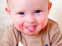 Drool Rashes In Baby: लार से भी हो सकते हैं बच्‍चों के चेहरे पर दाने और रैशेज, ऐसे रखें ख्‍याल 