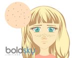 7 Natural Face Packs That Strip Blackheads