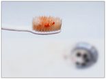 Weird Reasons Why Your Gums Are Bleeding