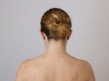 Best Treatments For Body Acne