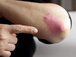 7 Common Foods That Make Psoriasis Worse!