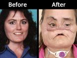 This Woman Got The First Face Transplant