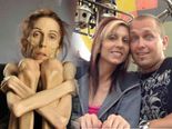 Story Of A Woman Who Suffered From Anorexia