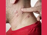 5 Home Treatments To Try If You Have Shingles